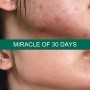 Some By Mi Aha Bha Pha 30 Days Miracle Toner Тонер для проблемної шкіри 